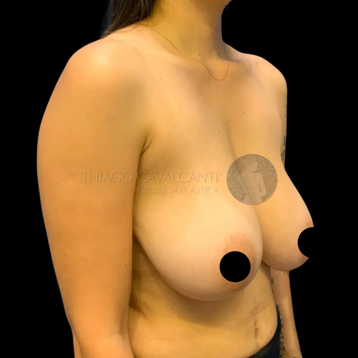 Mamoplastia Redutora - antes