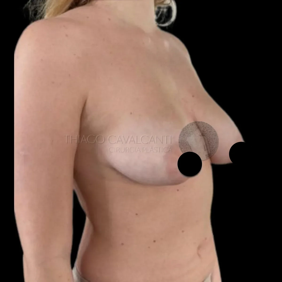 Mamoplastia Redutora - antes