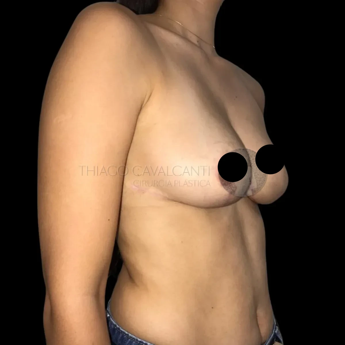 Mamoplastia Redutora - depois
