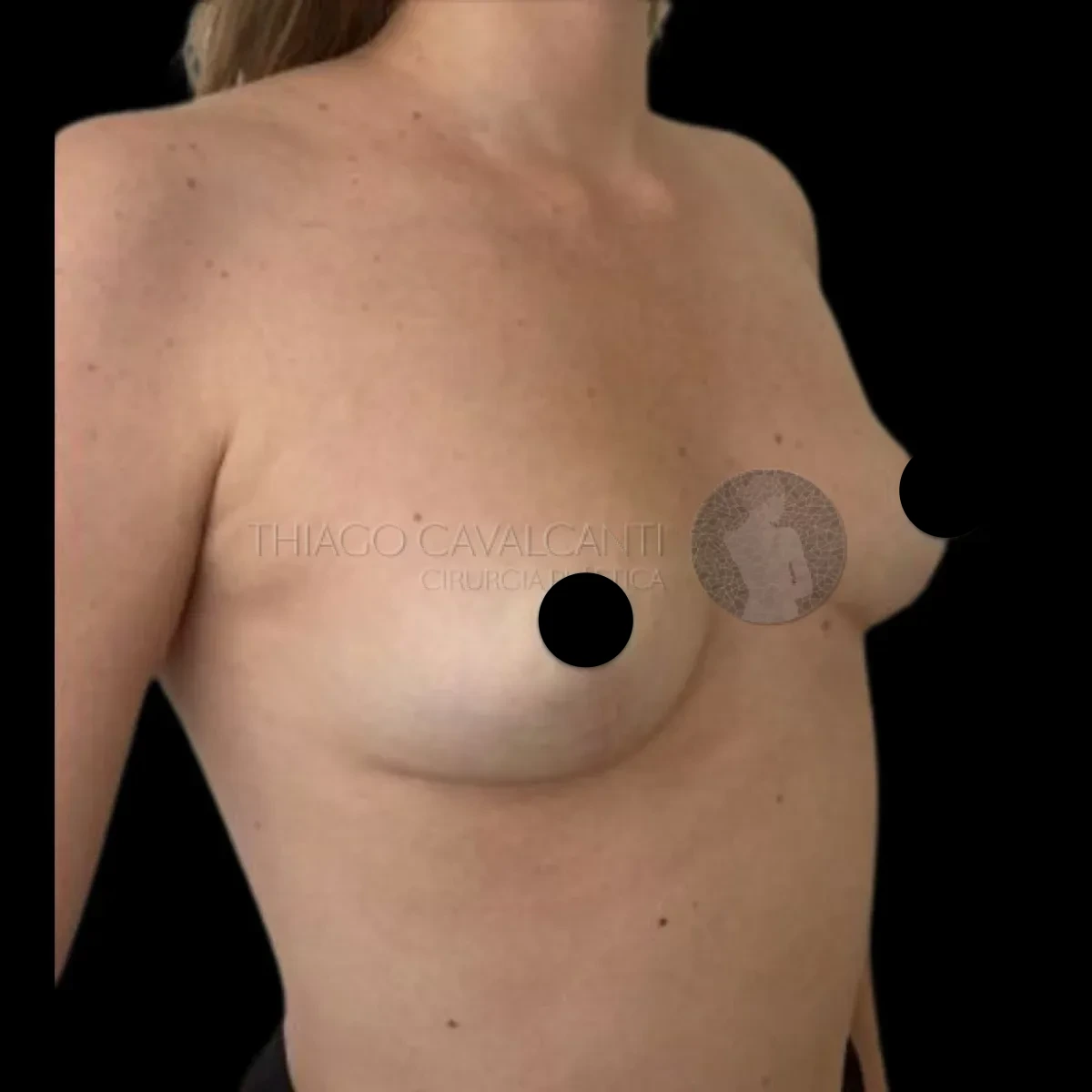 Mamoplastia Redutora - depois