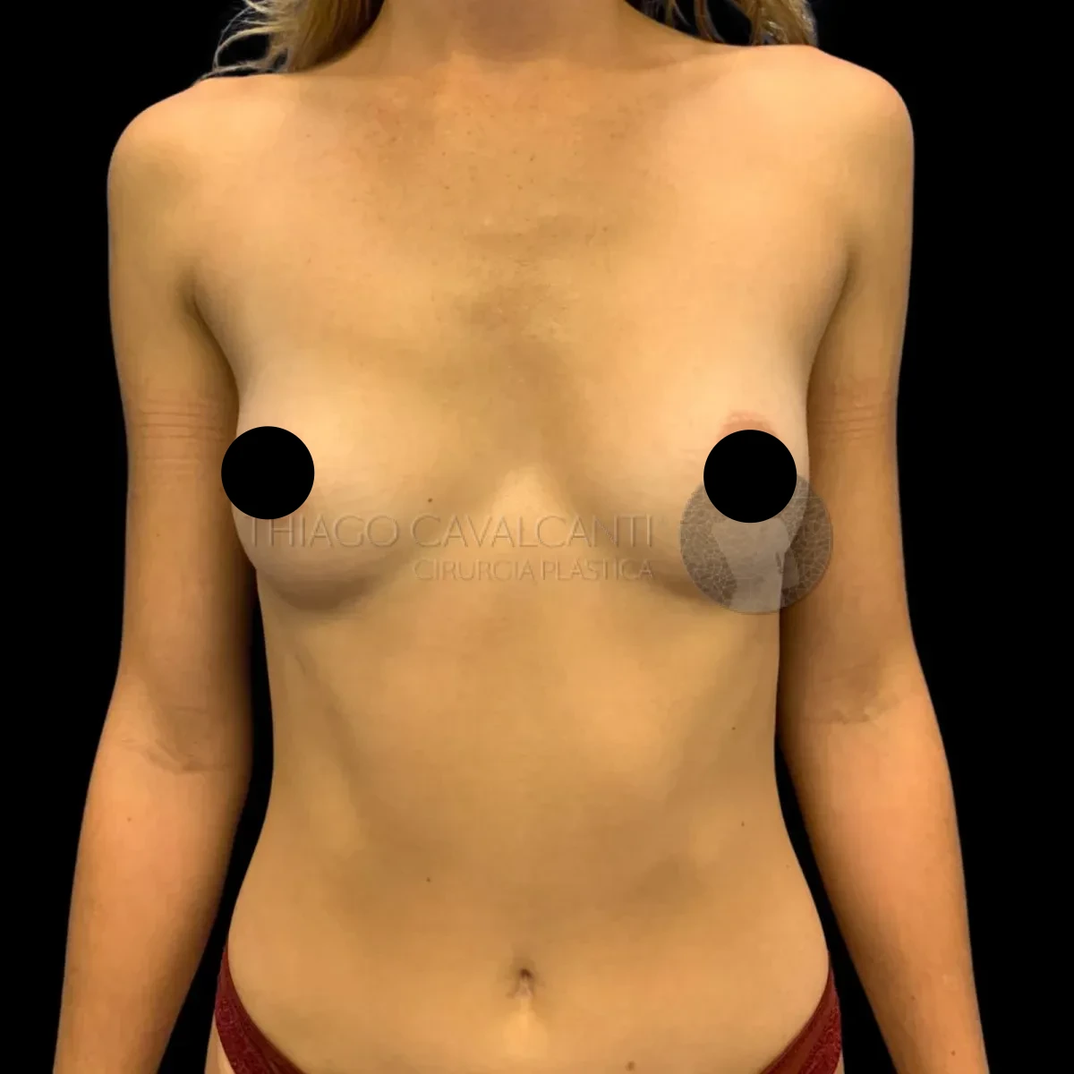 Prótese de Silicone R24R - antes