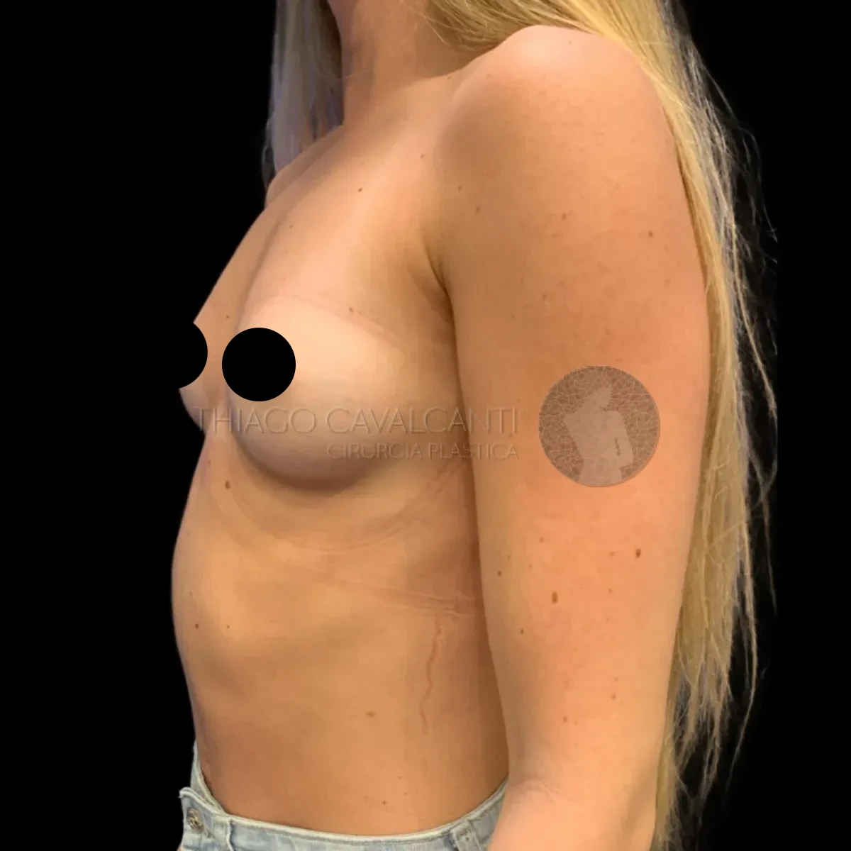 Prótese de Silicone R24R - antes