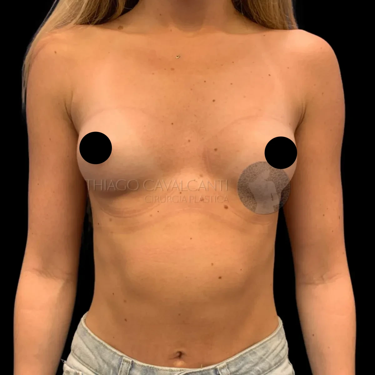 Prótese de Silicone R24R - antes
