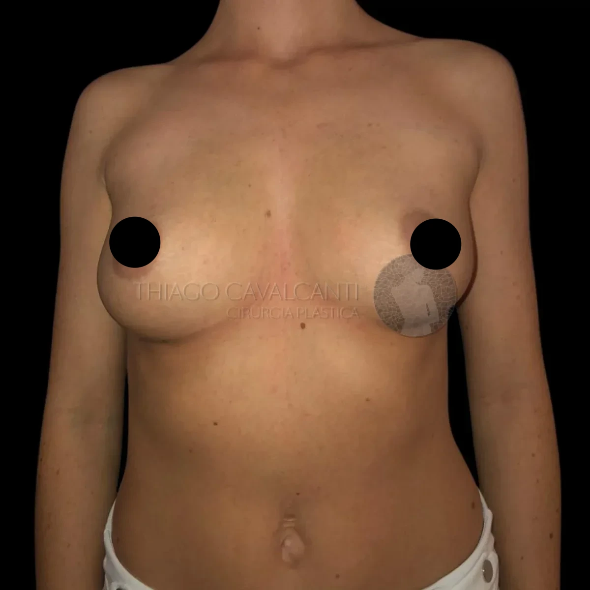 Prótese de Silicone R24R - antes
