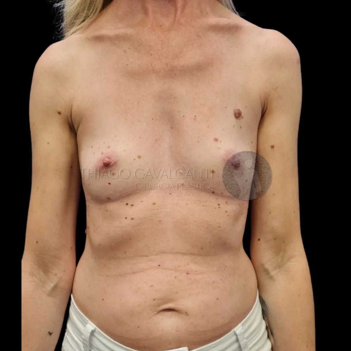 Prótese de Silicone R24R - antes