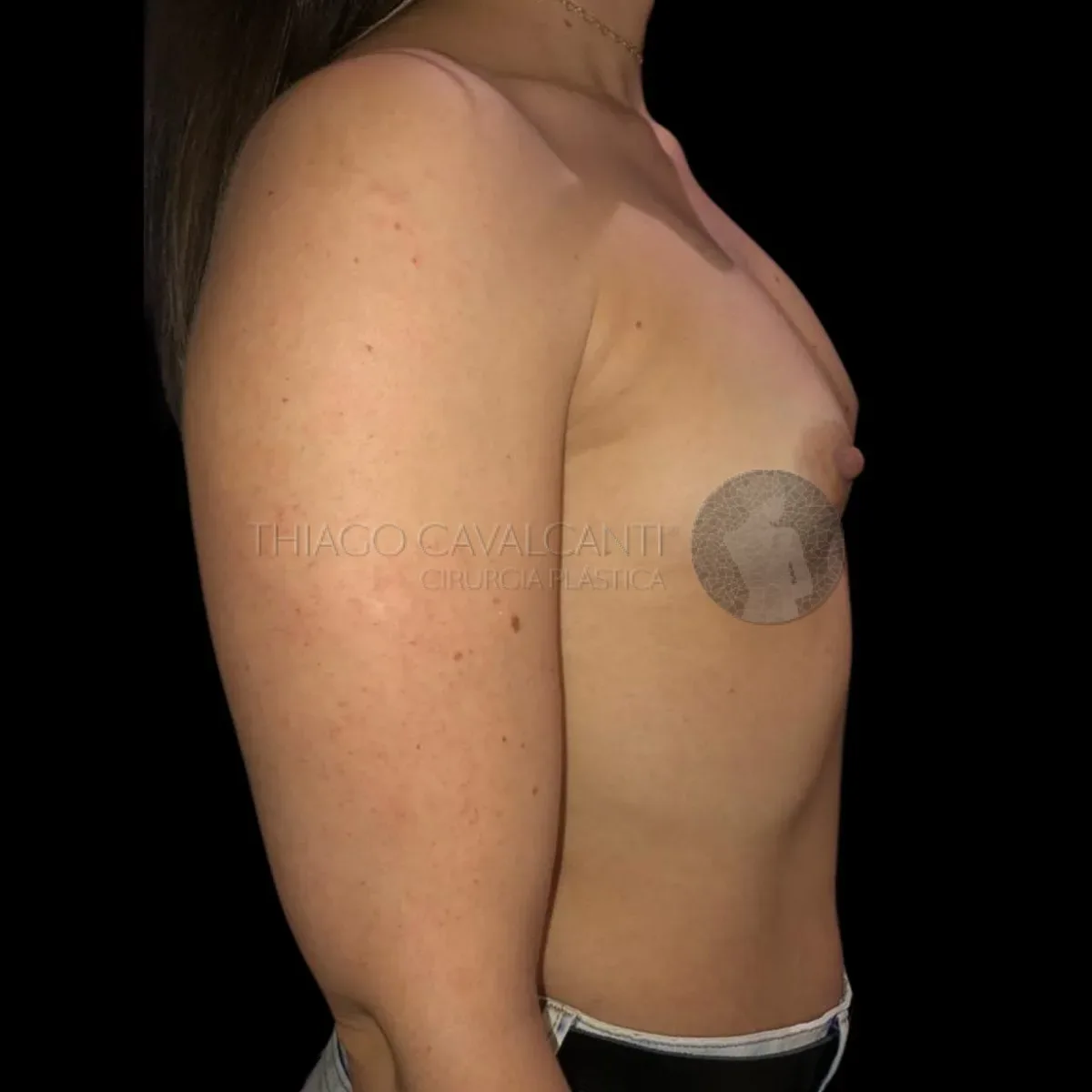 Prótese de Silicone R24R - antes