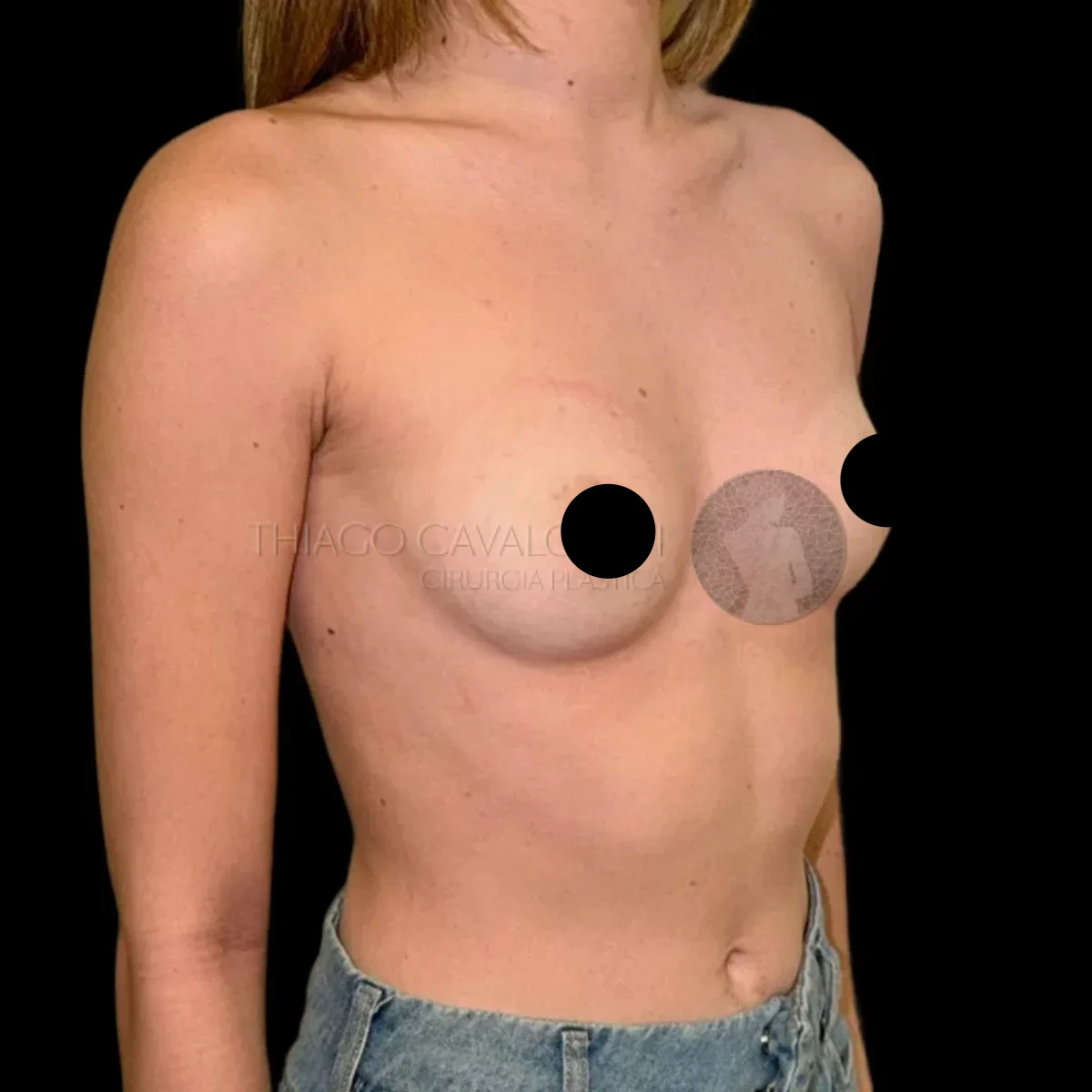 Prótese de Silicone R24R - antes