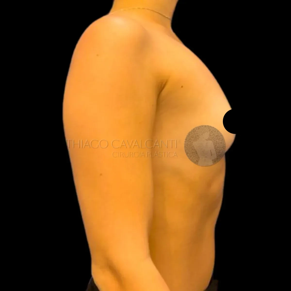 Prótese de Silicone R24R - antes