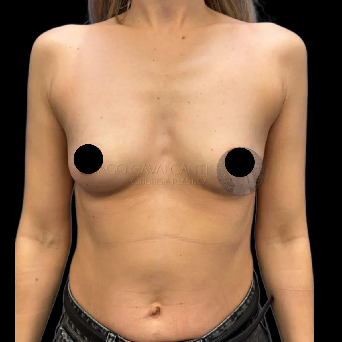 Prótese de Silicone R24R - antes