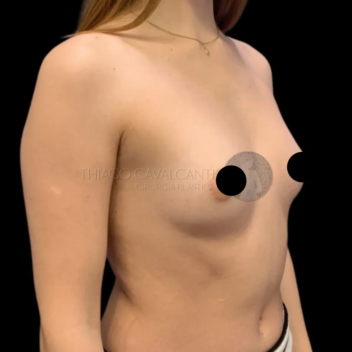 Prótese de Silicone R24R - antes