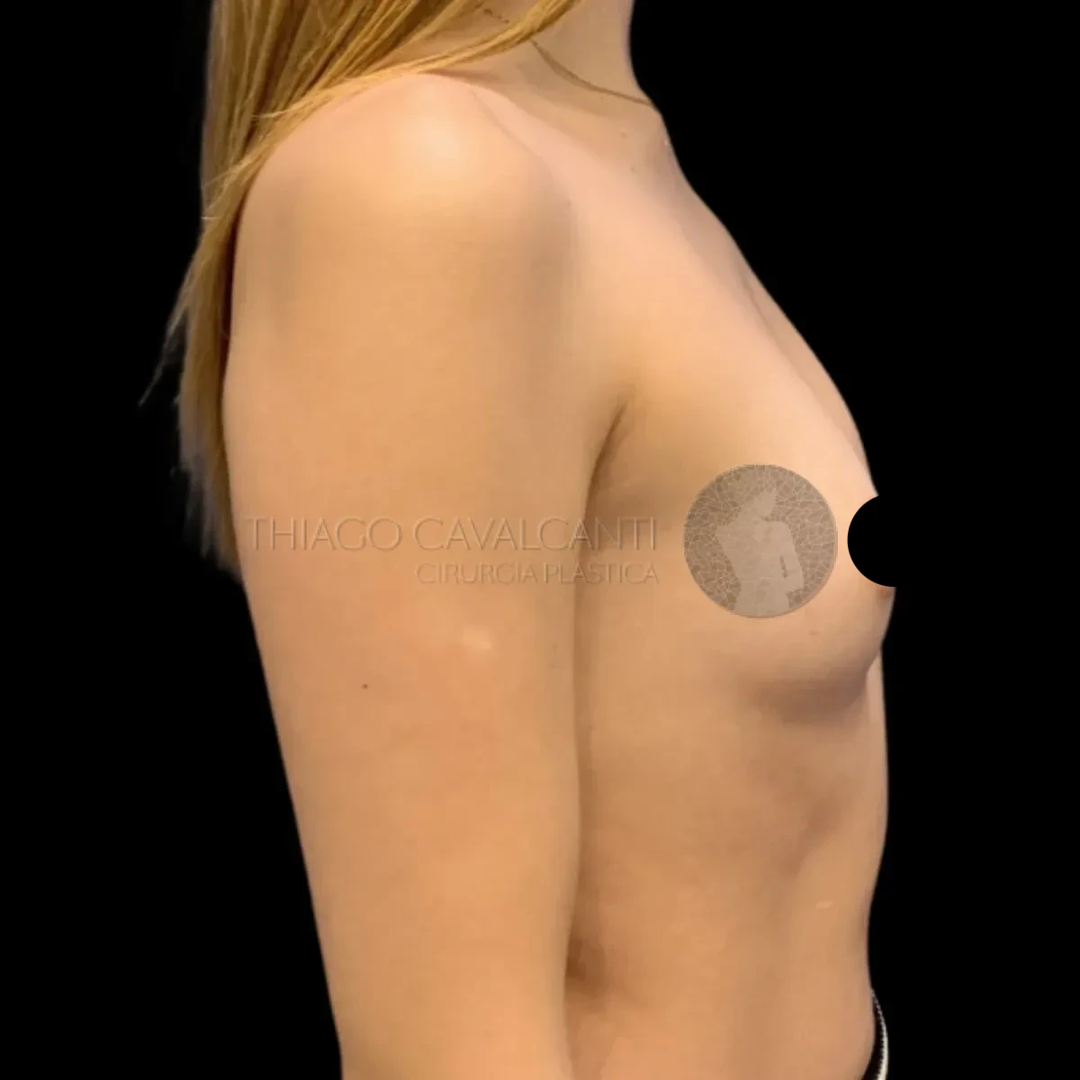 Prótese de Silicone R24R - antes