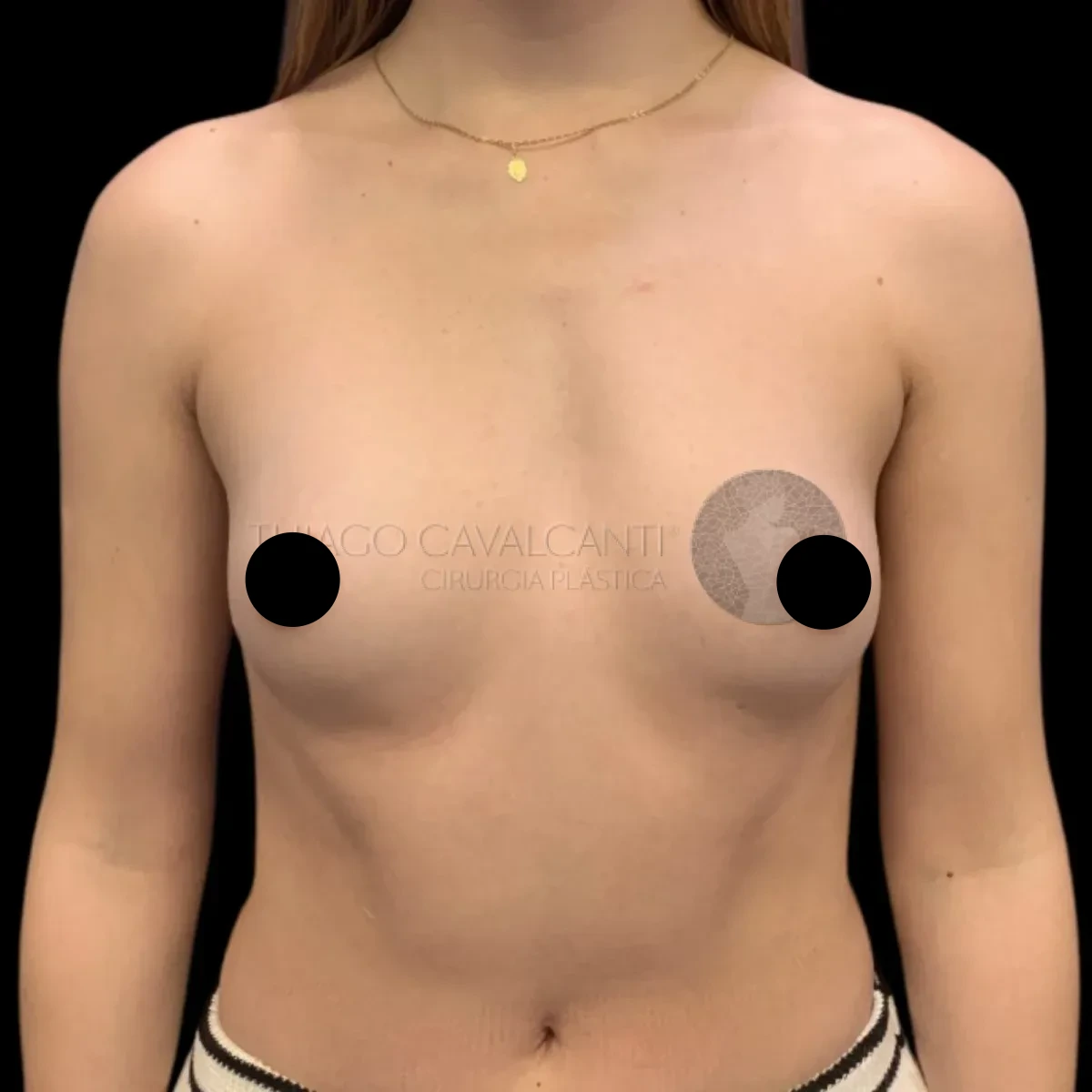 Prótese de Silicone R24R - antes