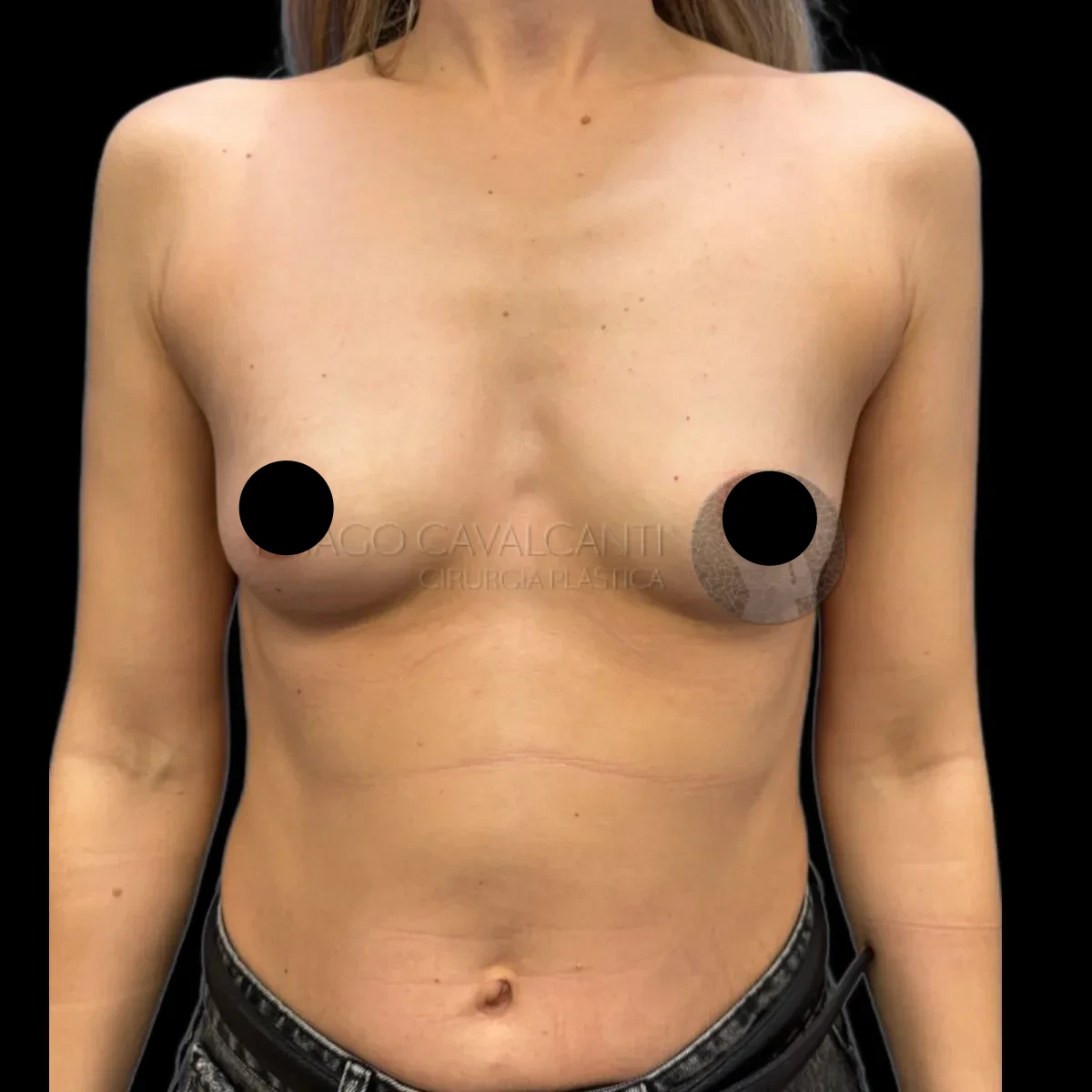 Prótese de Silicone R24R - antes