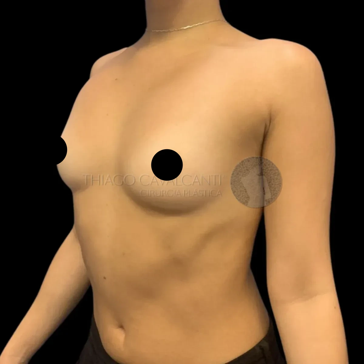 Prótese de Silicone R24R - antes