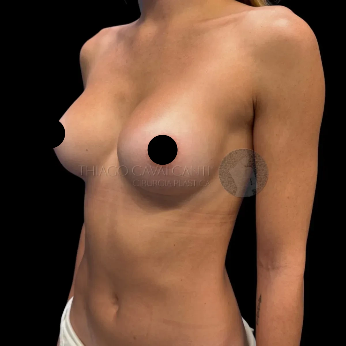 Prótese de Silicone R24R - depois