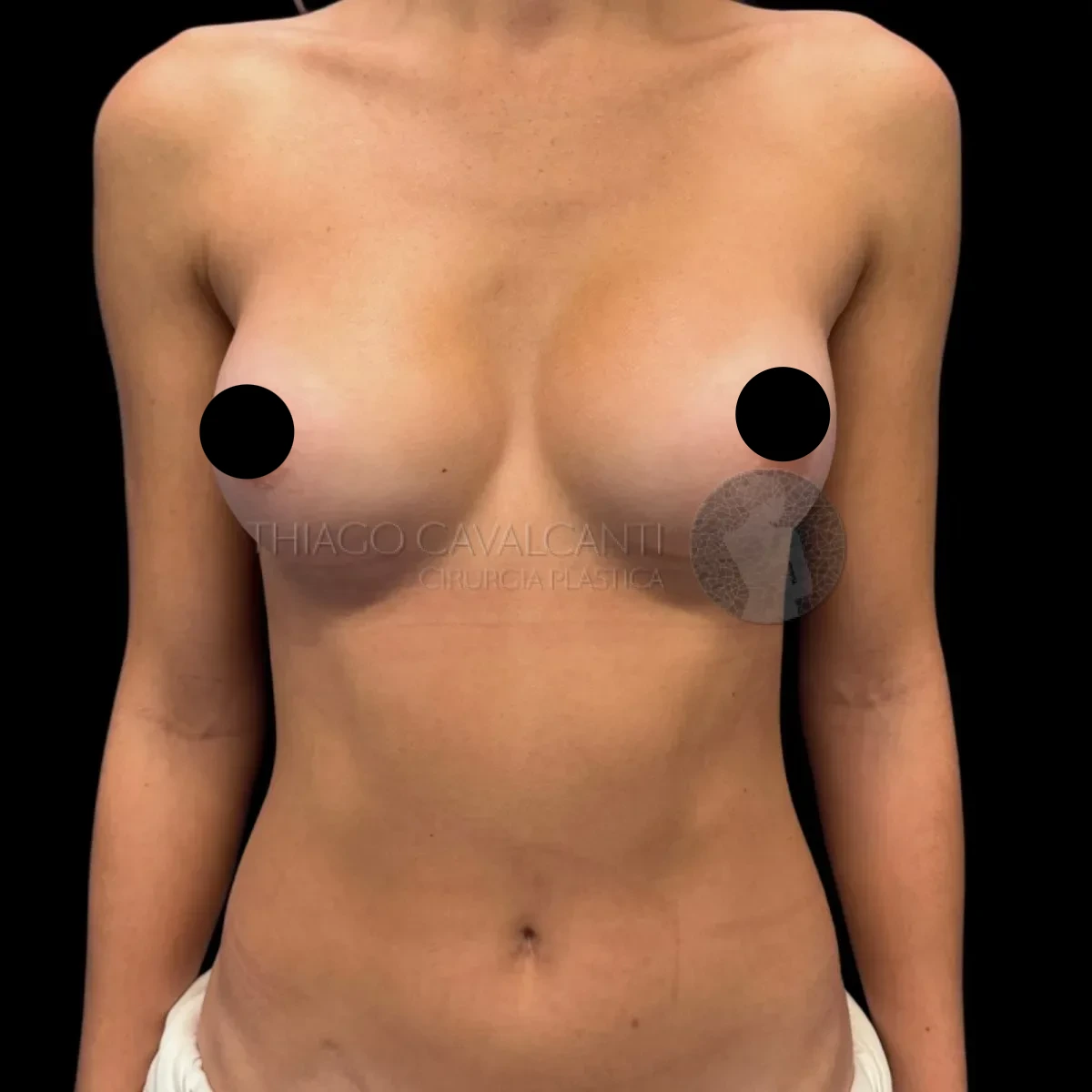 Prótese de Silicone R24R - depois