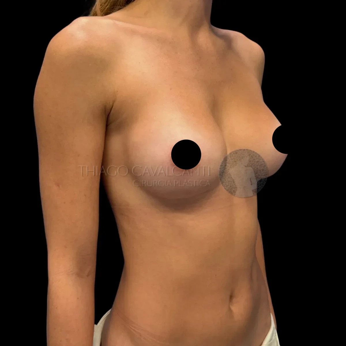 Prótese de Silicone R24R - depois