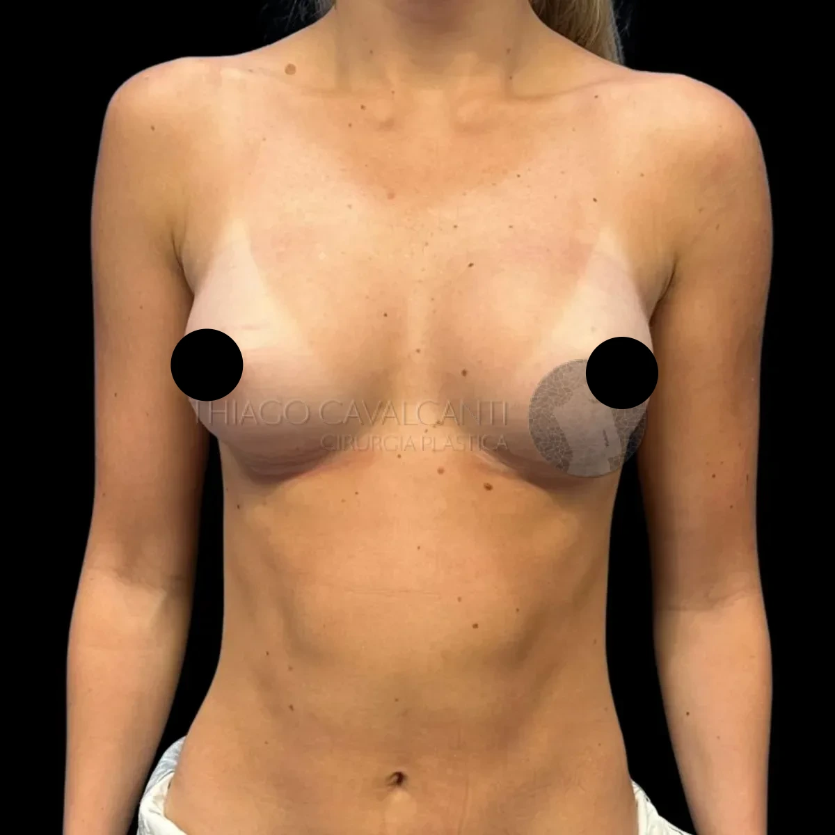 Prótese de Silicone R24R - depois