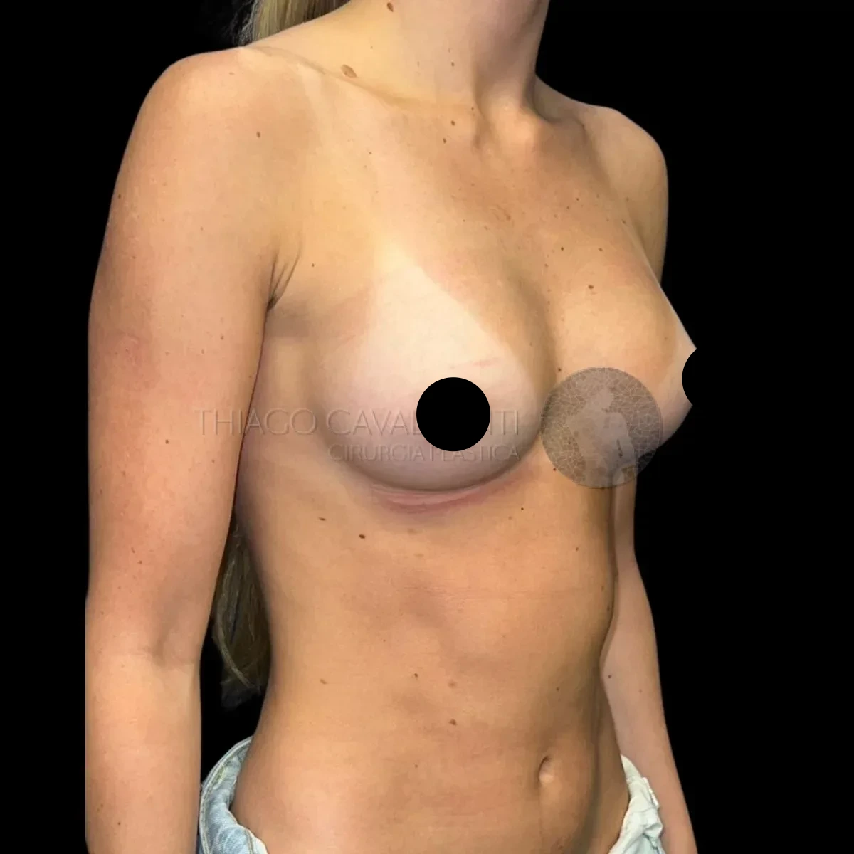 Prótese de Silicone R24R - depois