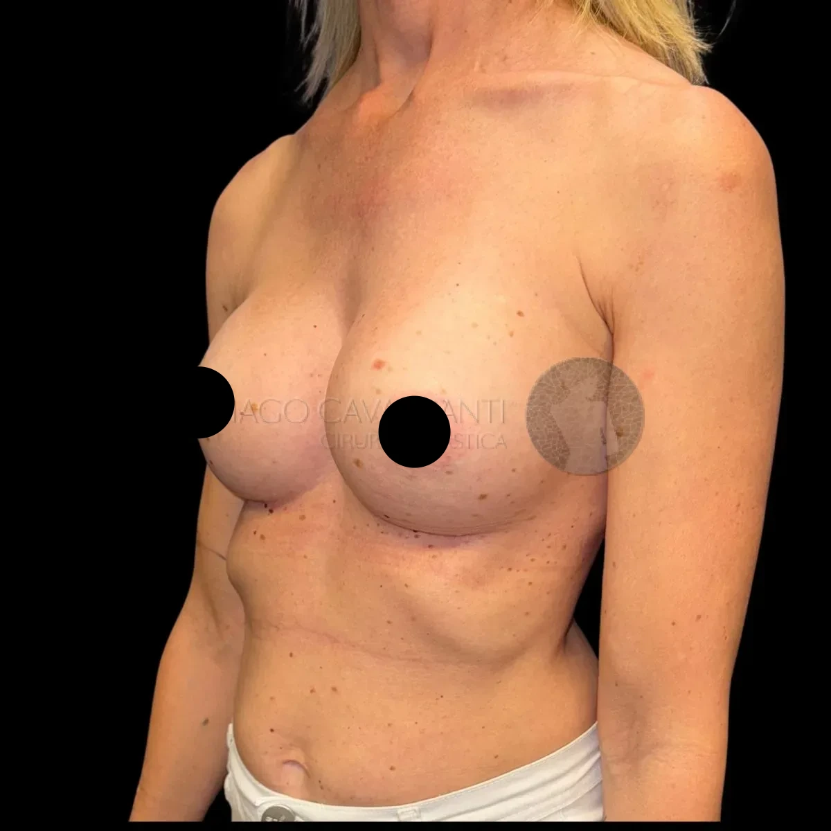 Prótese de Silicone R24R - depois