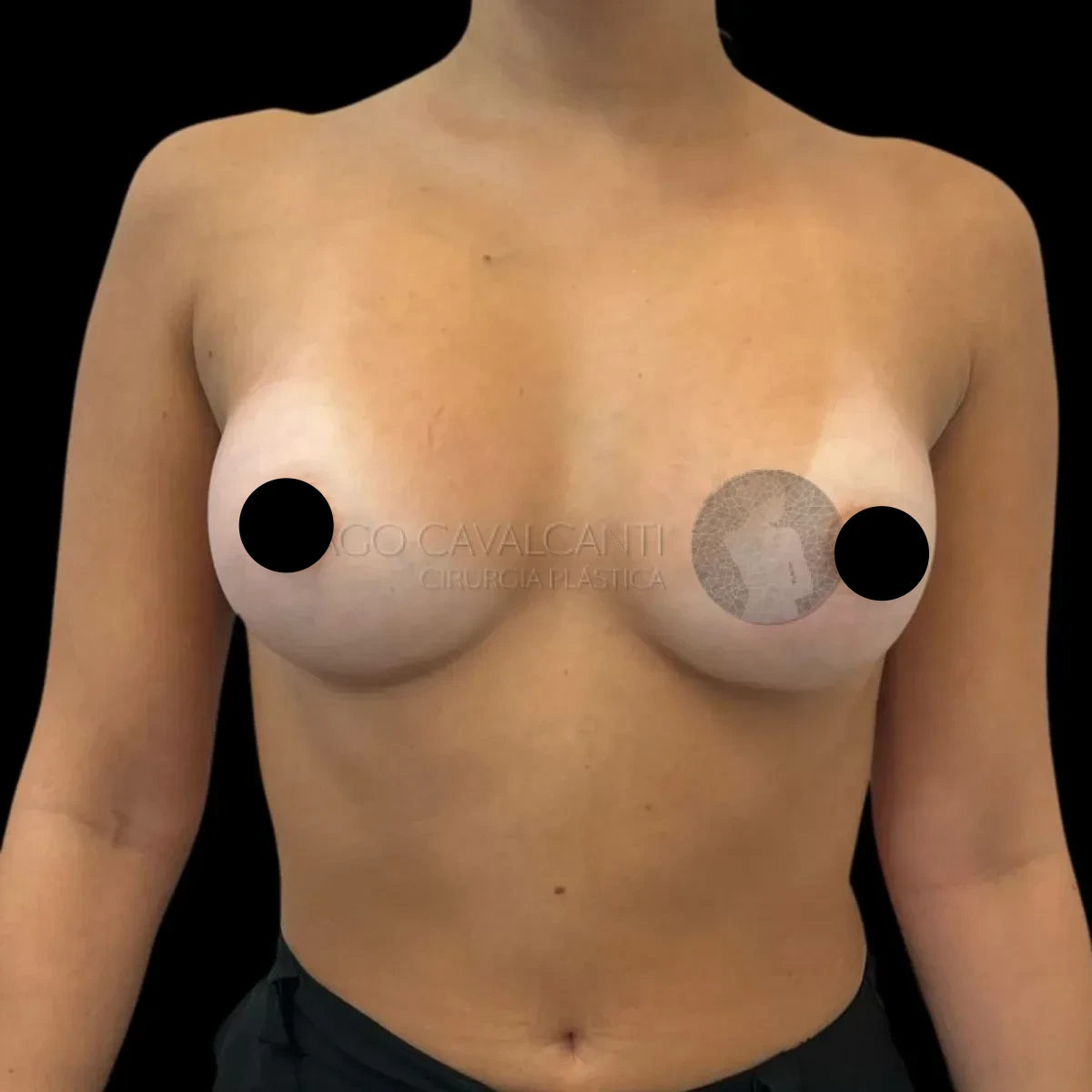 Prótese de Silicone R24R - depois