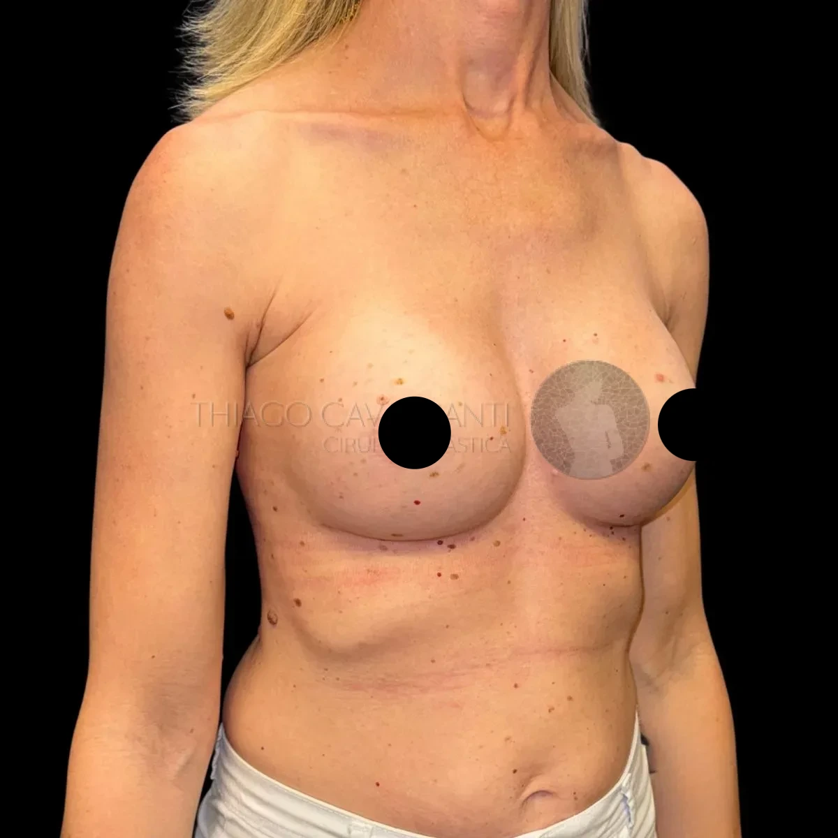 Prótese de Silicone R24R - depois