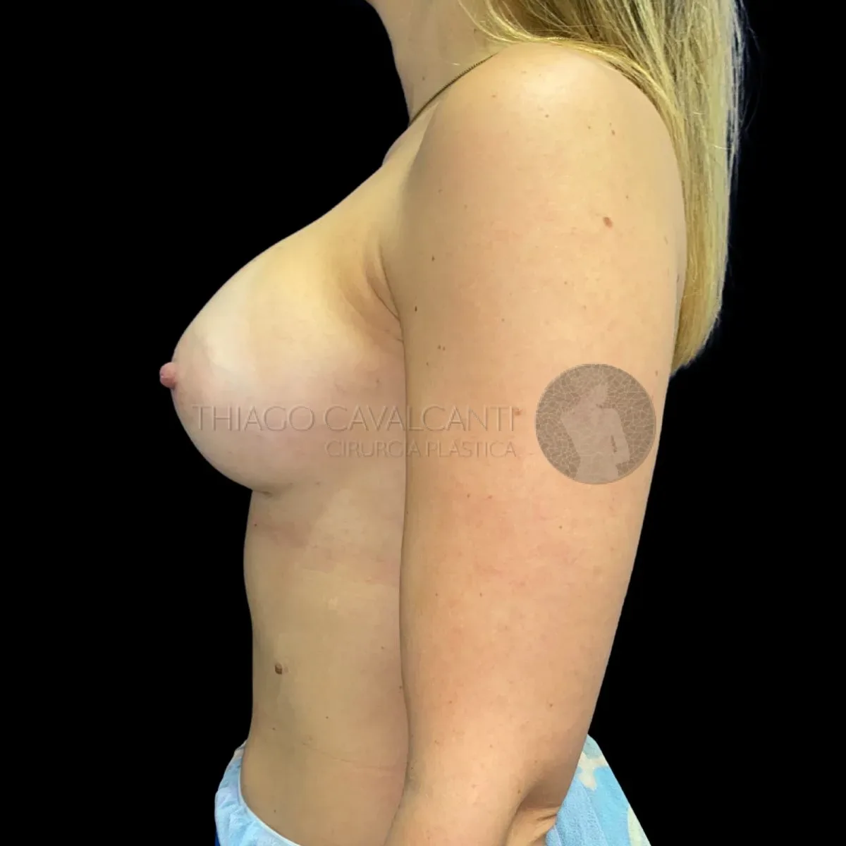 Prótese de Silicone R24R - depois