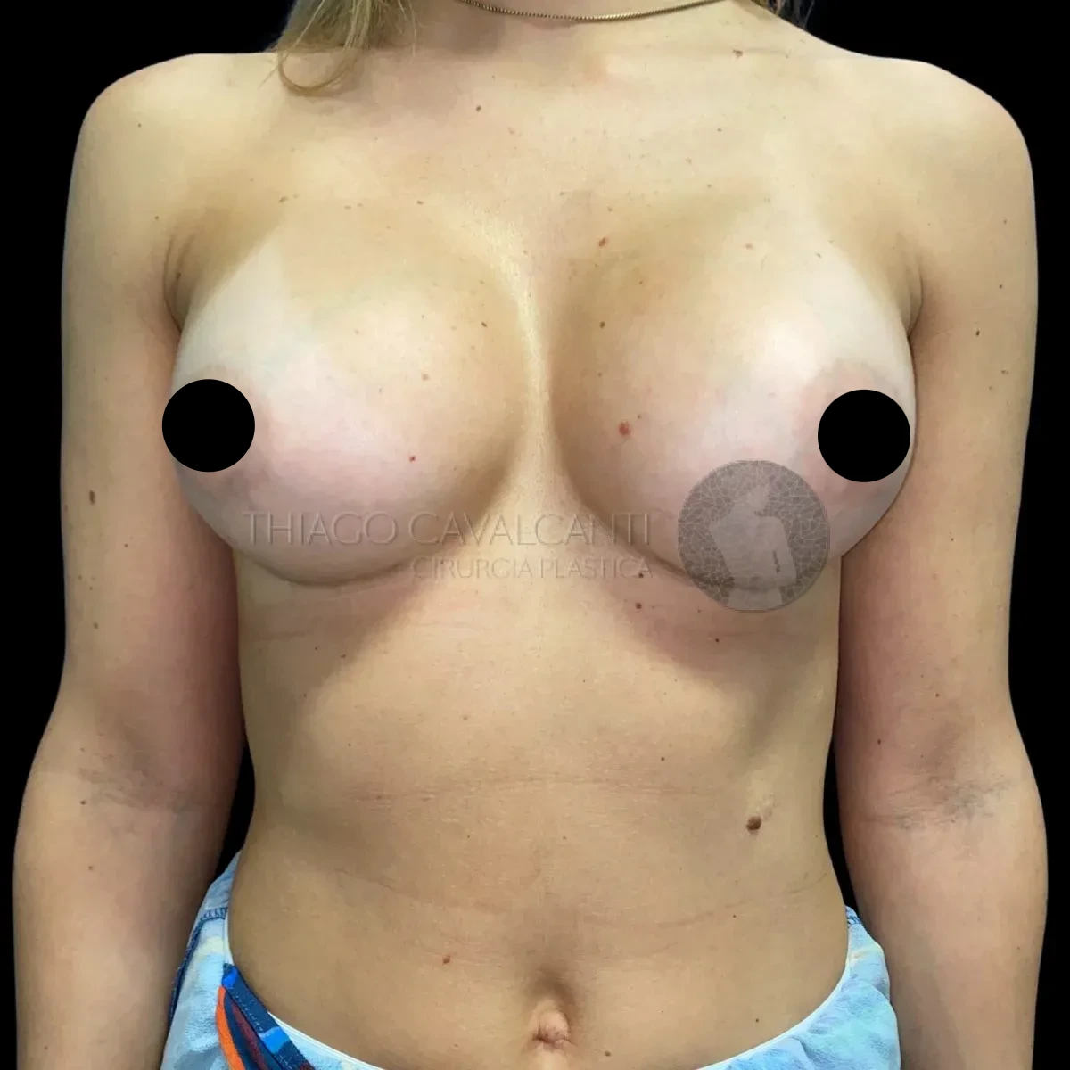 Prótese de Silicone R24R - depois