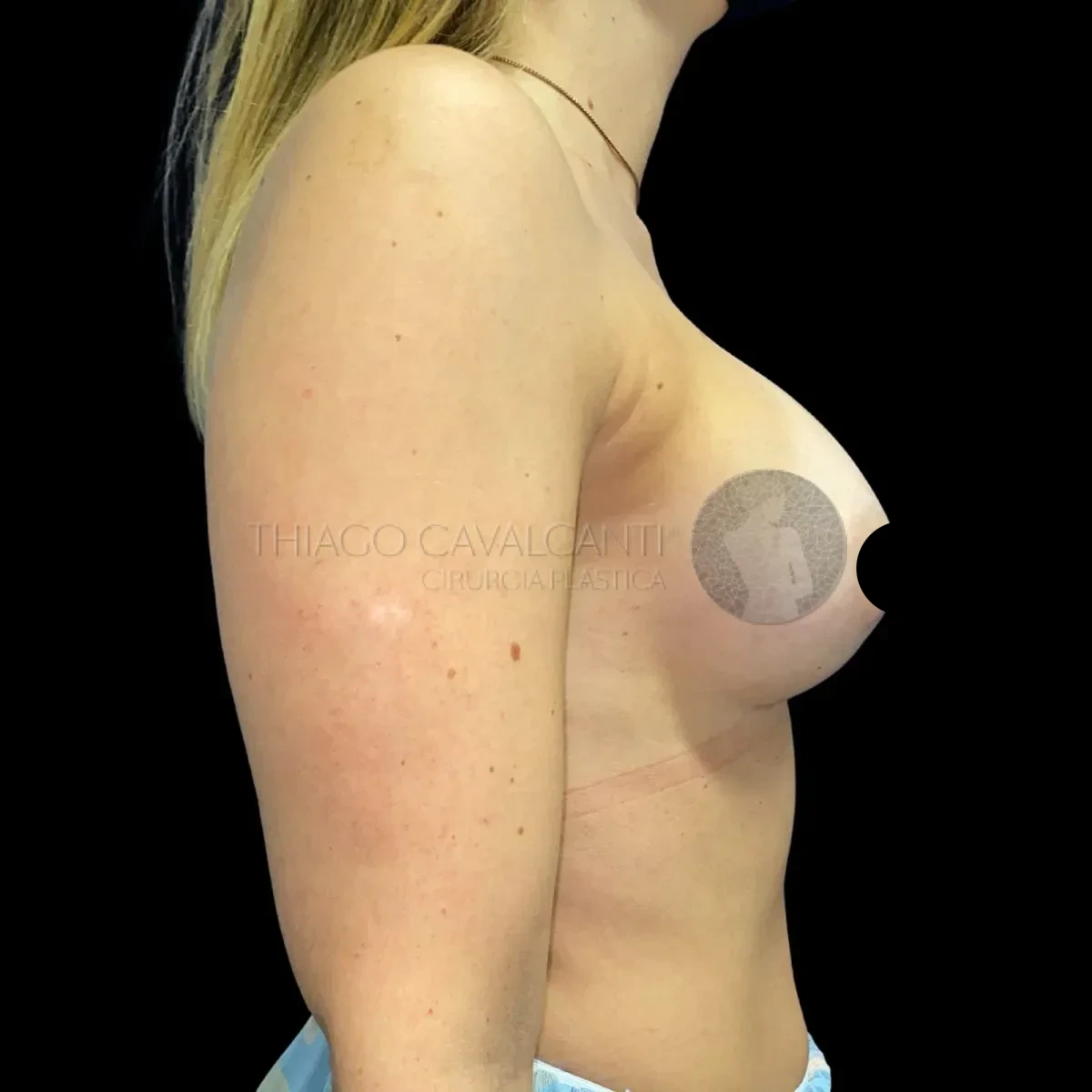 Prótese de Silicone R24R - depois