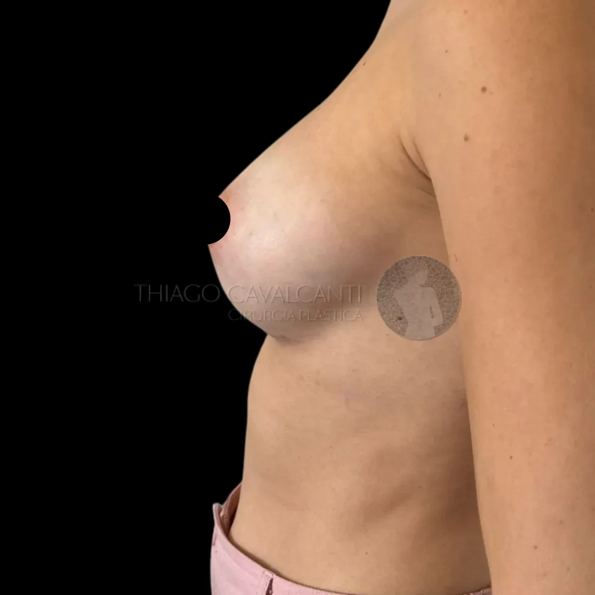 Prótese de Silicone R24R - depois