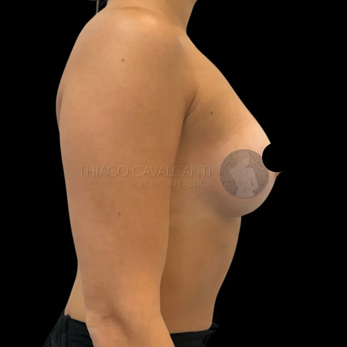 Prótese de Silicone R24R - depois
