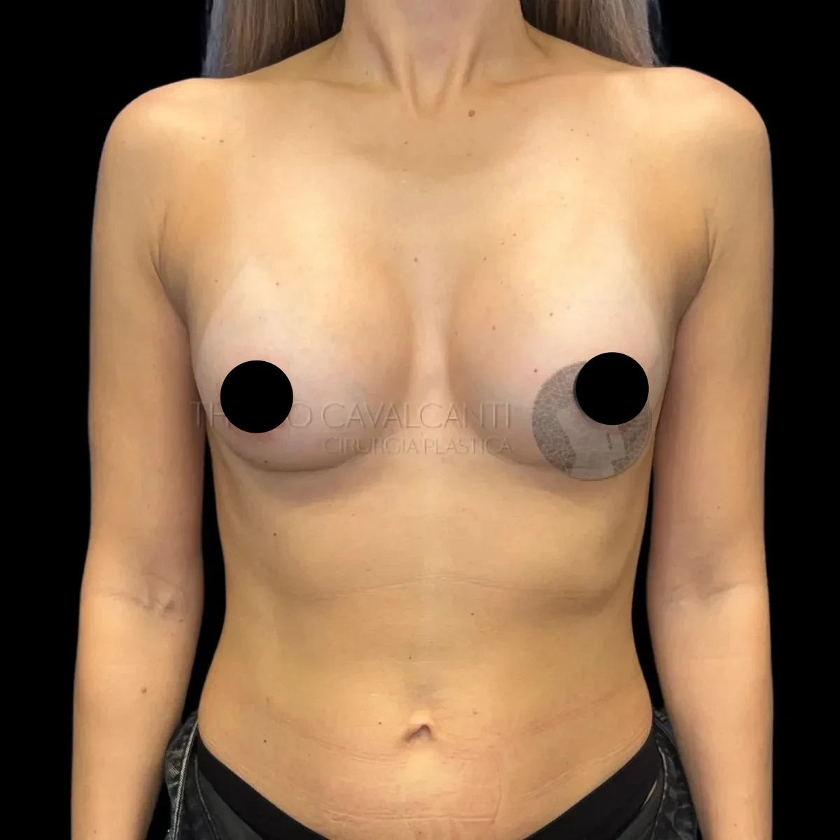 Prótese de Silicone R24R - depois