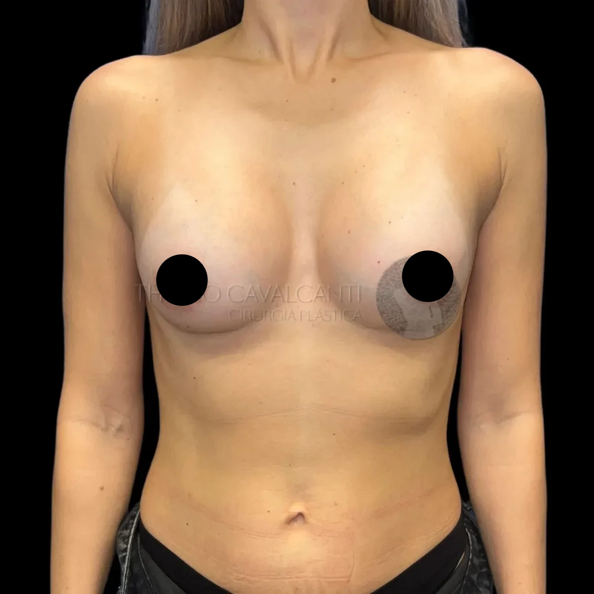 Prótese de Silicone R24R - depois