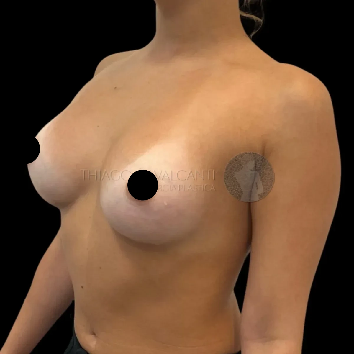 Prótese de Silicone R24R - depois